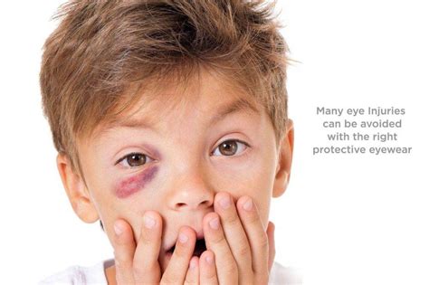 Blackeye.
